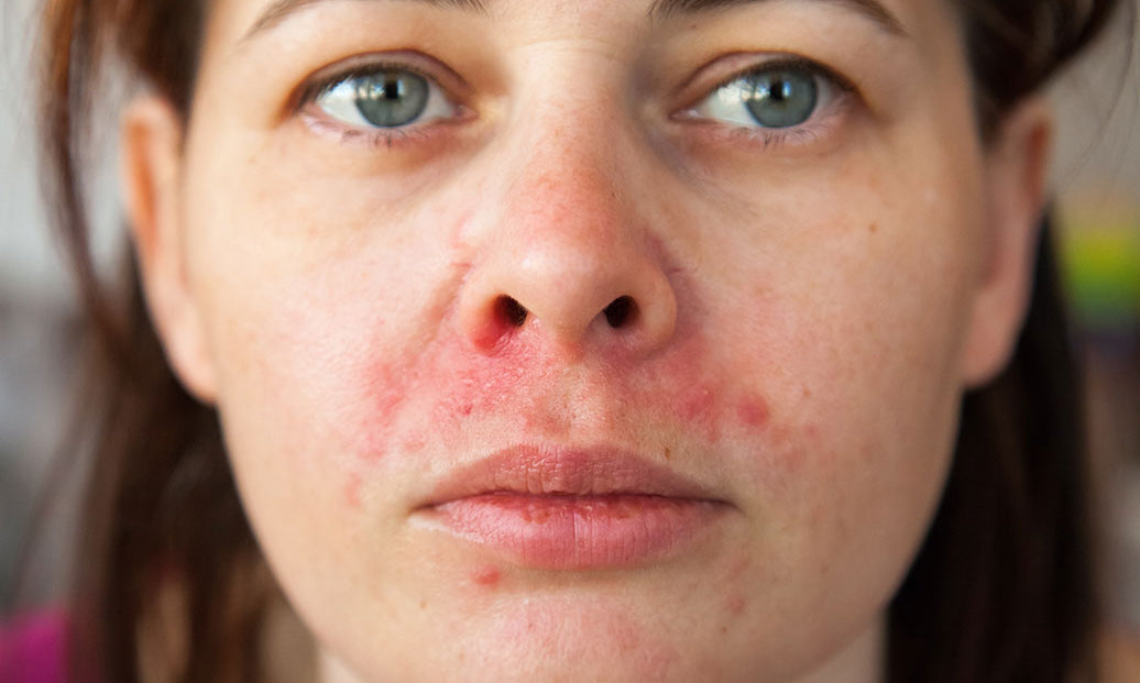 What Is The Best Face Wash For Perioral Dermatitis?