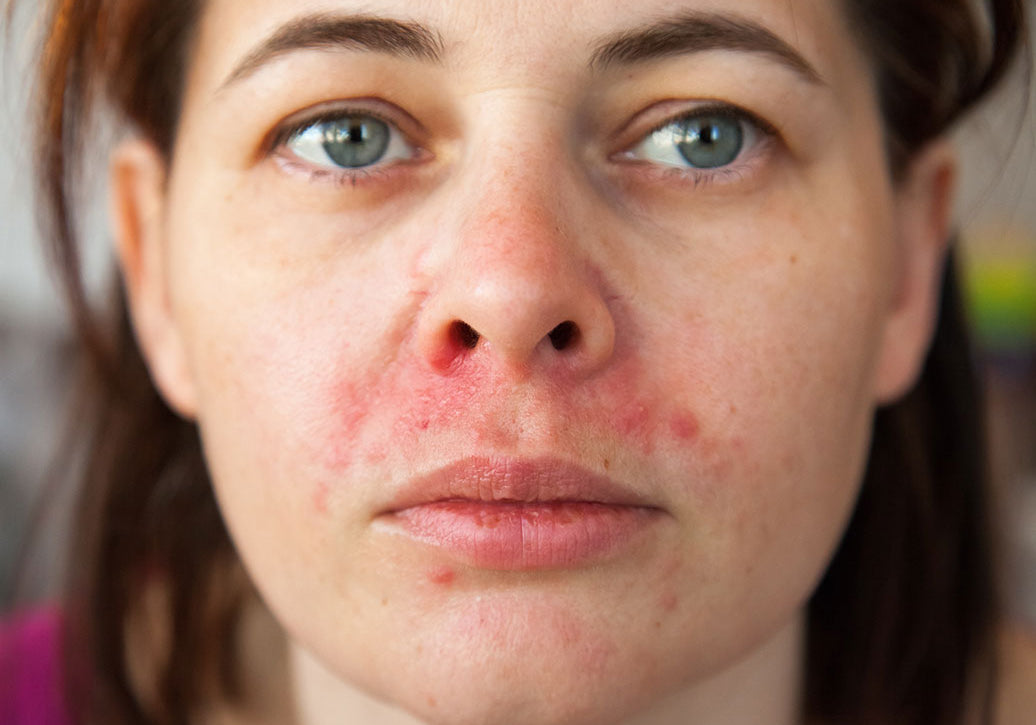 What Is The Best Face Wash For Perioral Dermatitis?