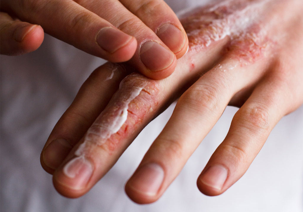 Which Hand Cream Is Best For Skin In Winter?