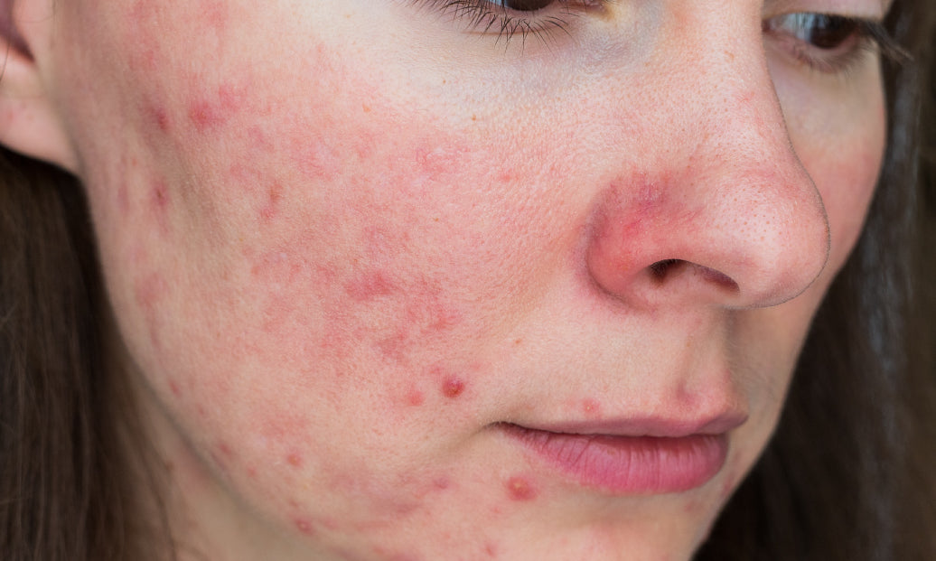 an example of rosacea on a cheek