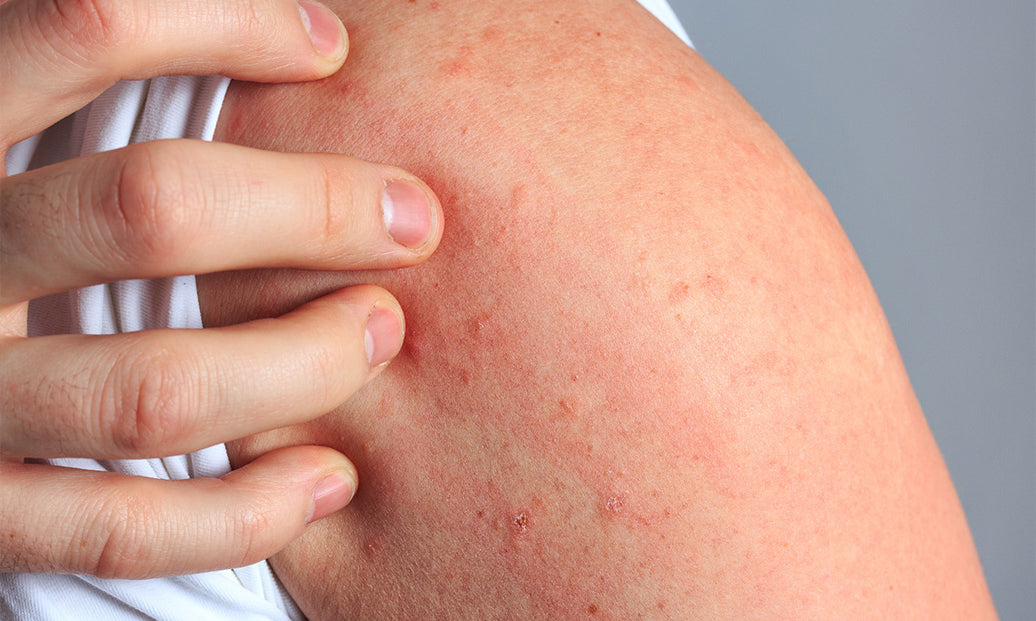 Why Do I Suddenly Have Dermatitis?