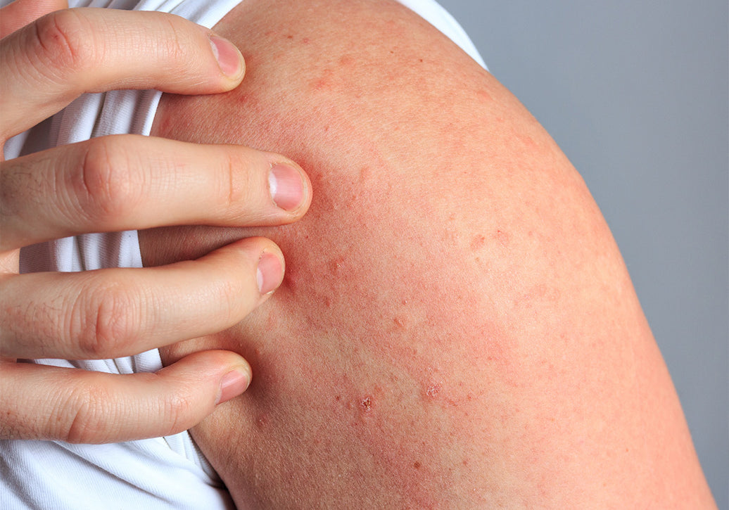 Why Do I Suddenly Have Dermatitis?