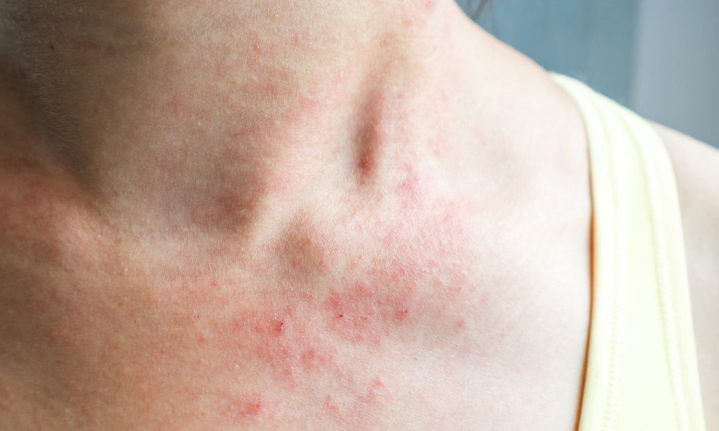 eczema around the neck