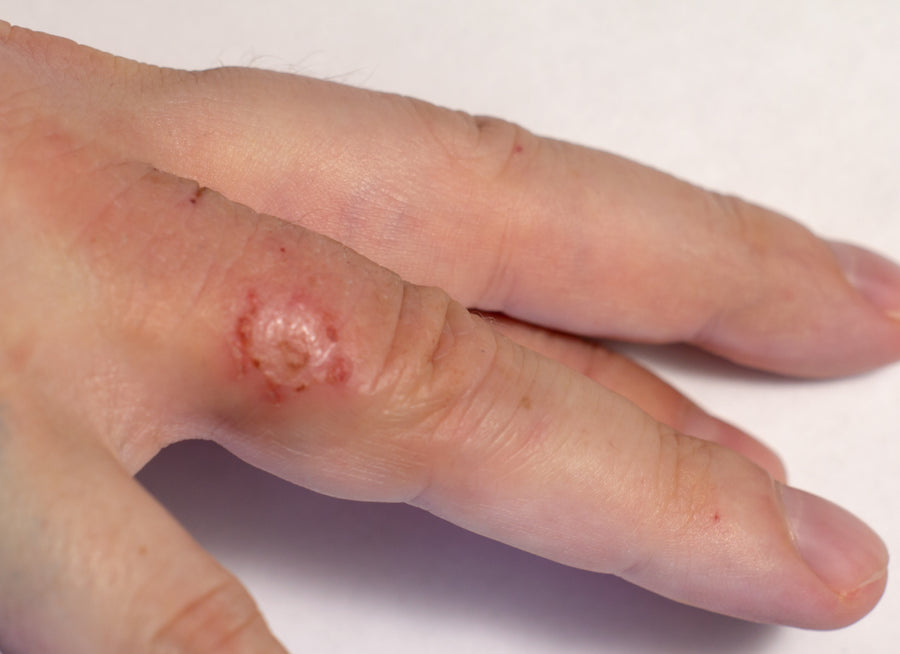 Nummular Eczema on the inside of an index finger