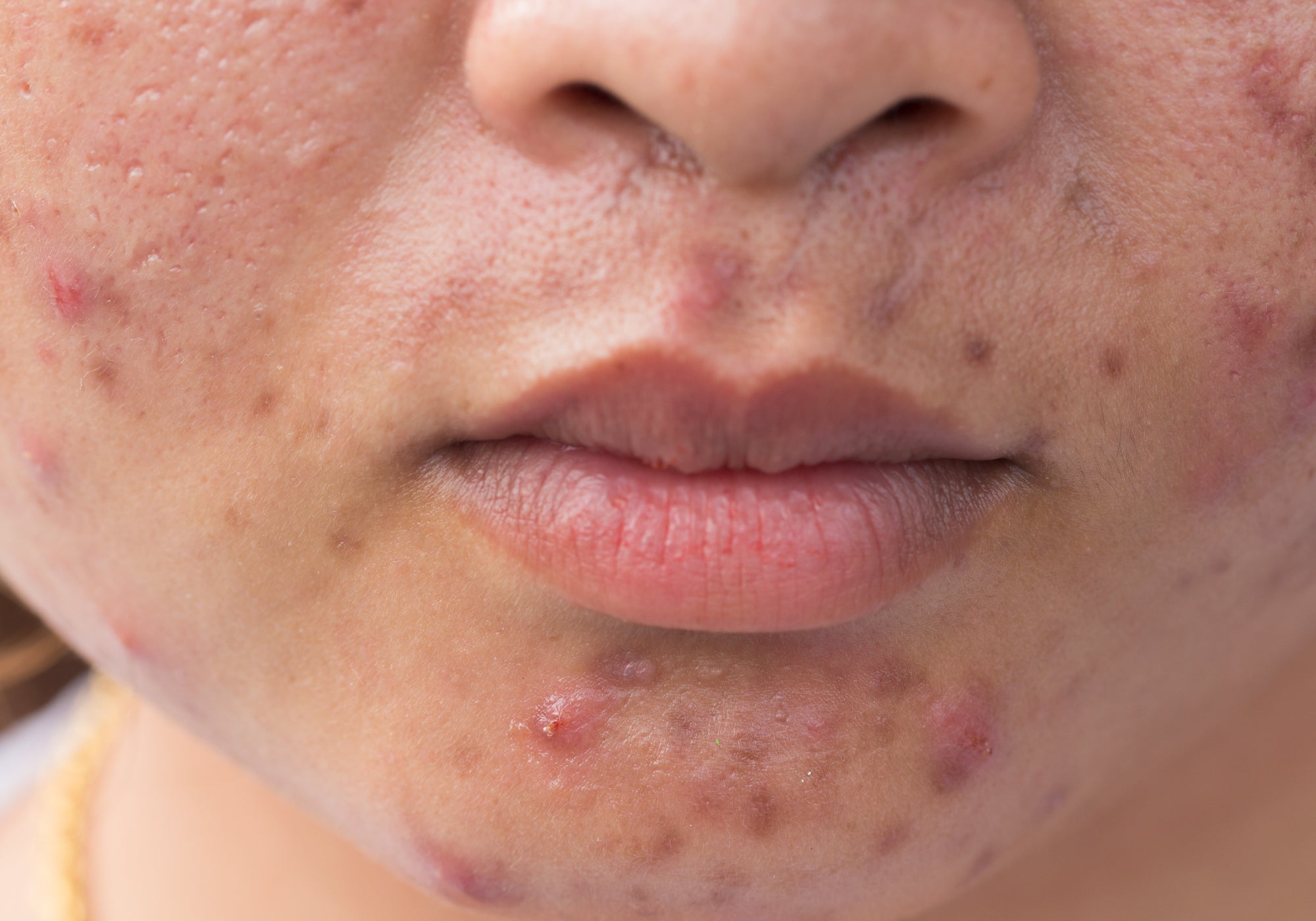 What Does Acne Rosacea Look Like?