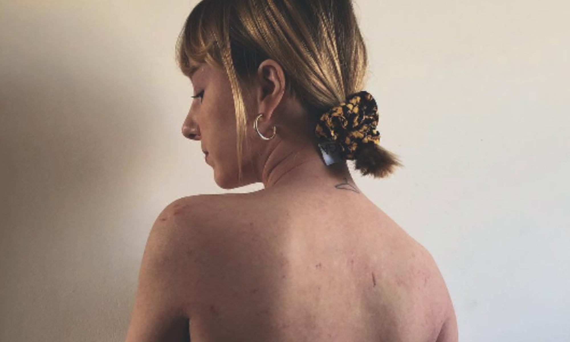 Eczema & Me: My Experience of Immunosuppressant Therapy