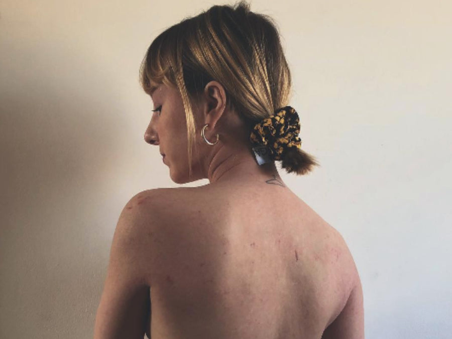Eczema & Me: My Experience of Immunosuppressant Therapy
