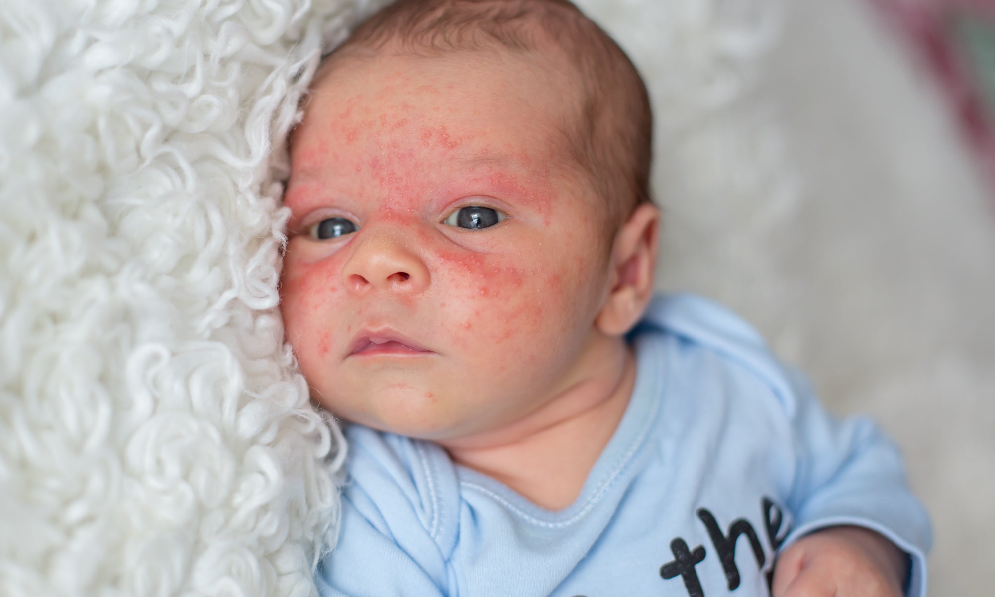 How To Tell If Your Baby Has Eczema or Infant Acne