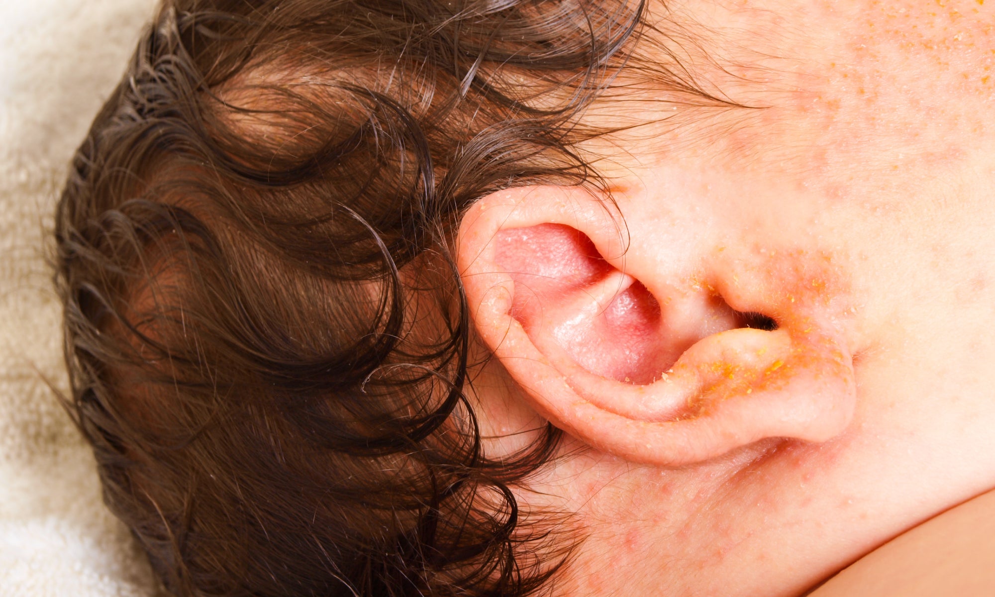 baby with ear eczema