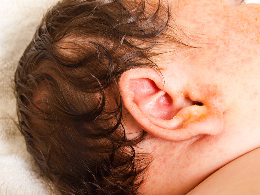 baby with ear eczema
