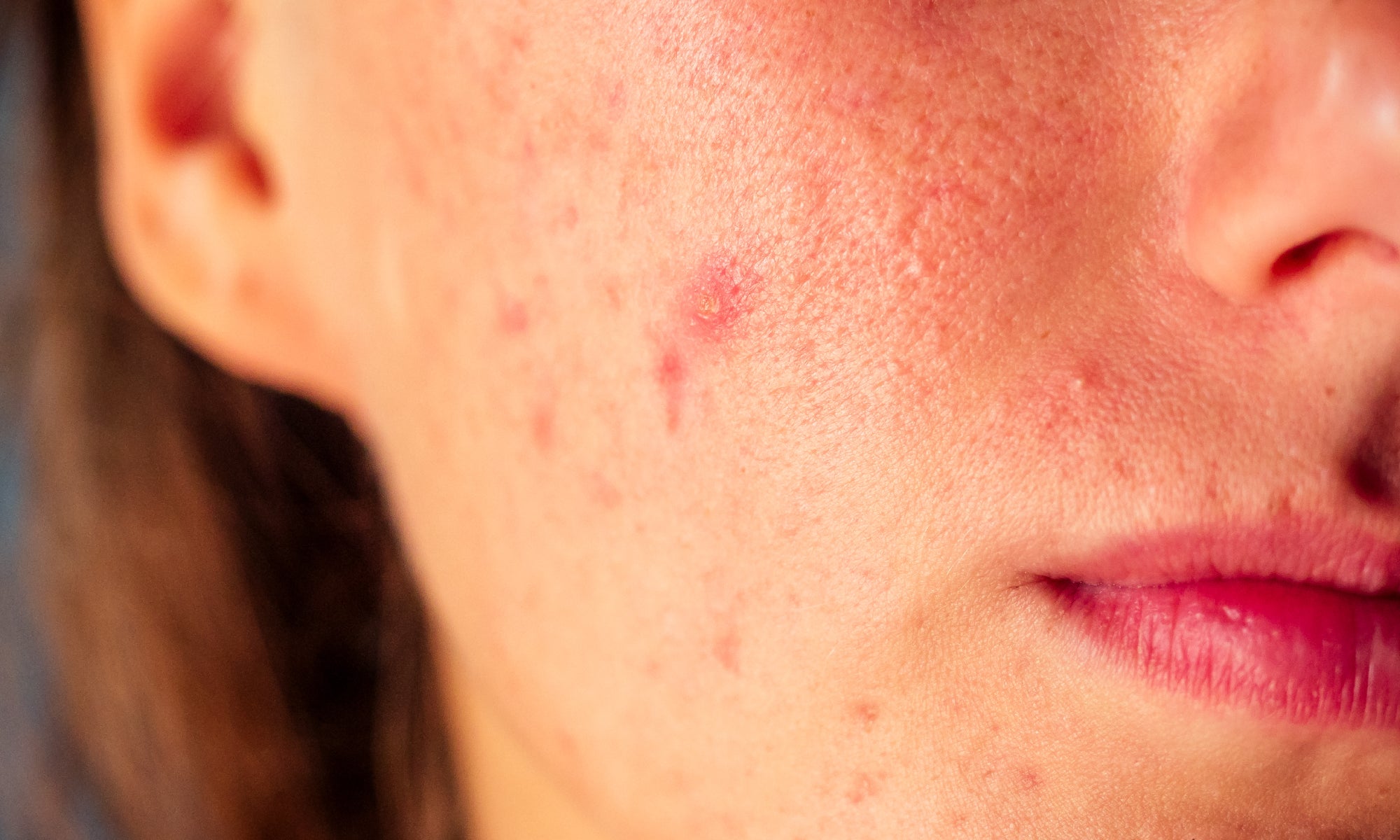 Can Acne Rosacea Go Away On Its Own?