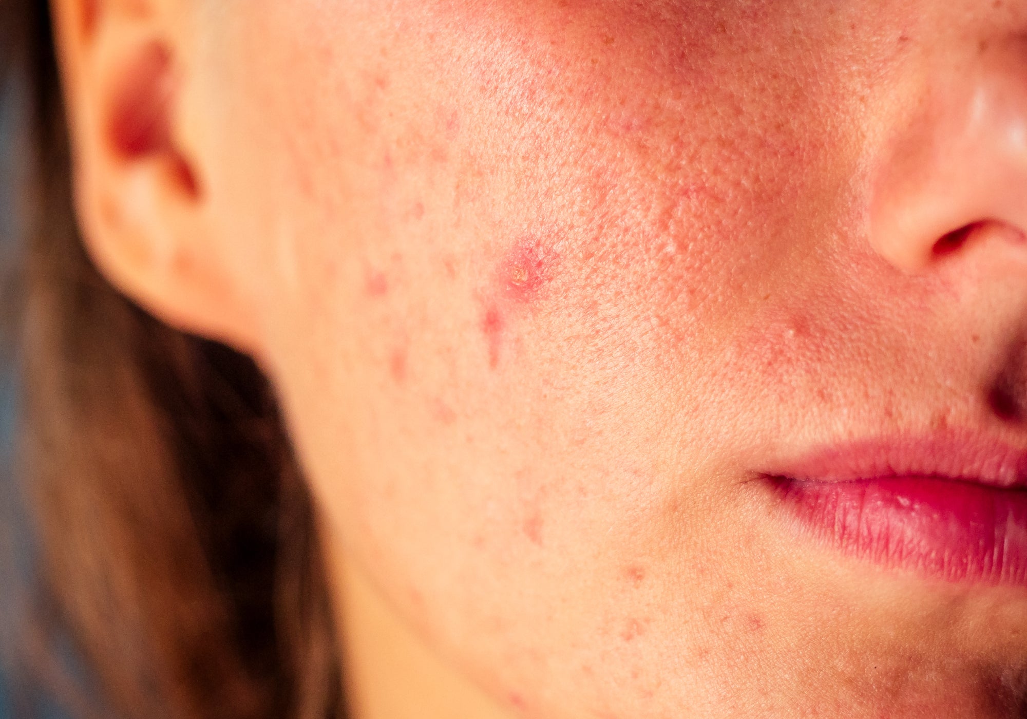 Can Acne Rosacea Go Away On Its Own?