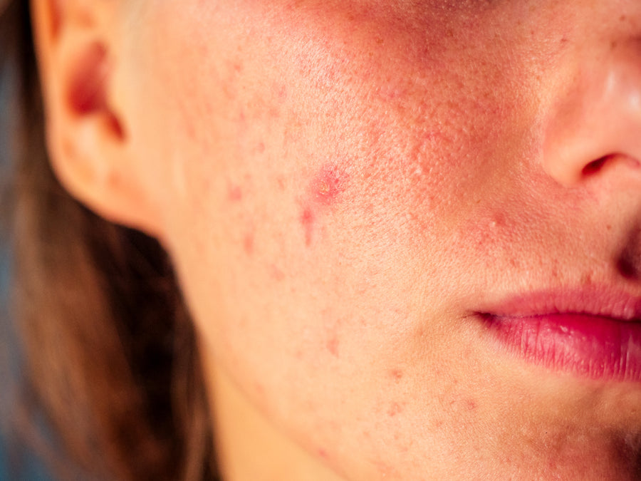 Can Acne Rosacea Go Away On Its Own?
