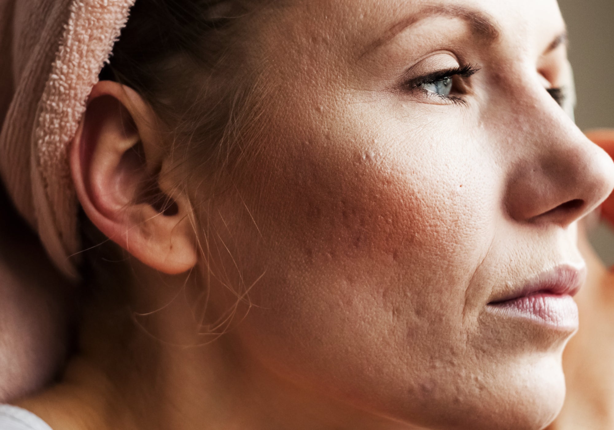 Top 6 Triggers of Acne Rosacea