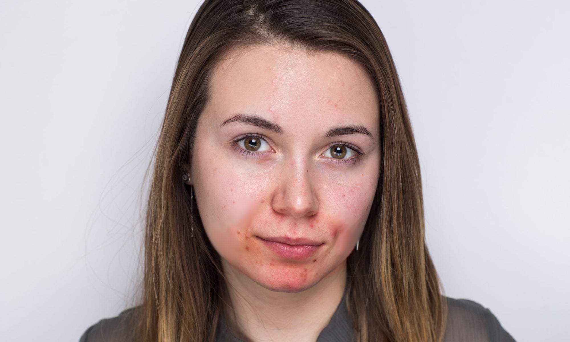 What is Acne Rosacea?