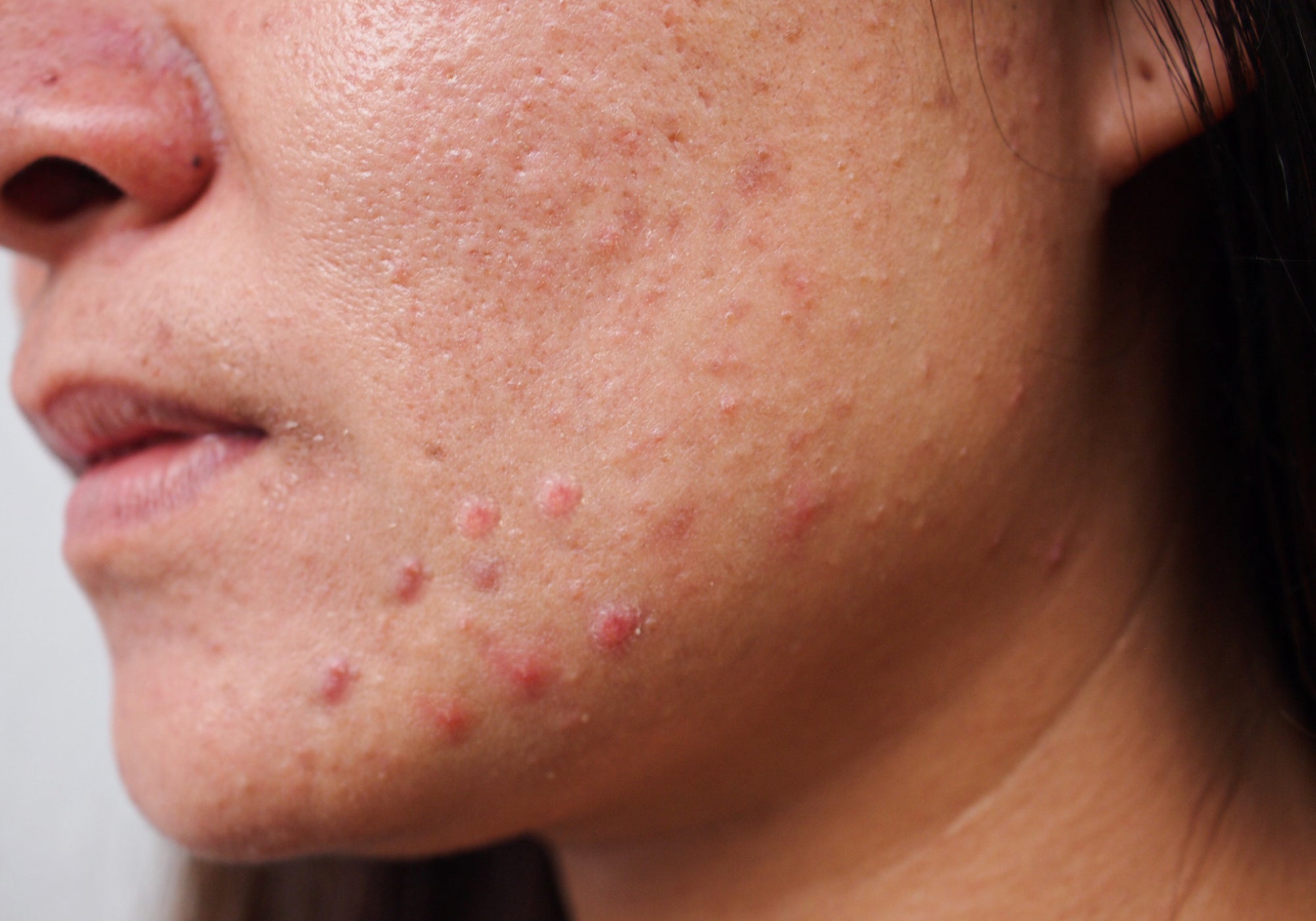 Is It Possible To Get Rid Of Acne Rosacea?