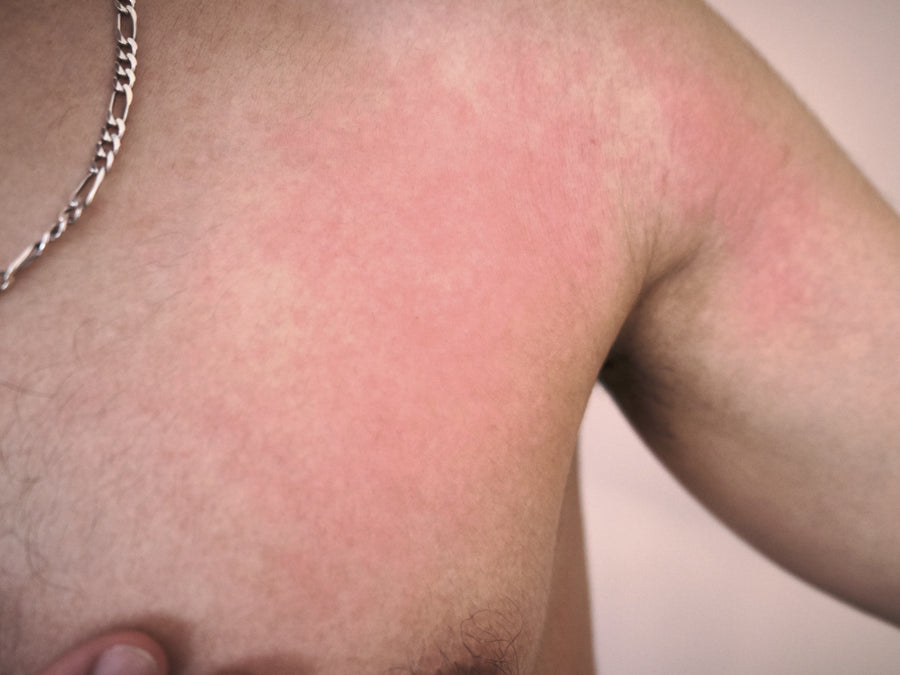 radiation rash on chest