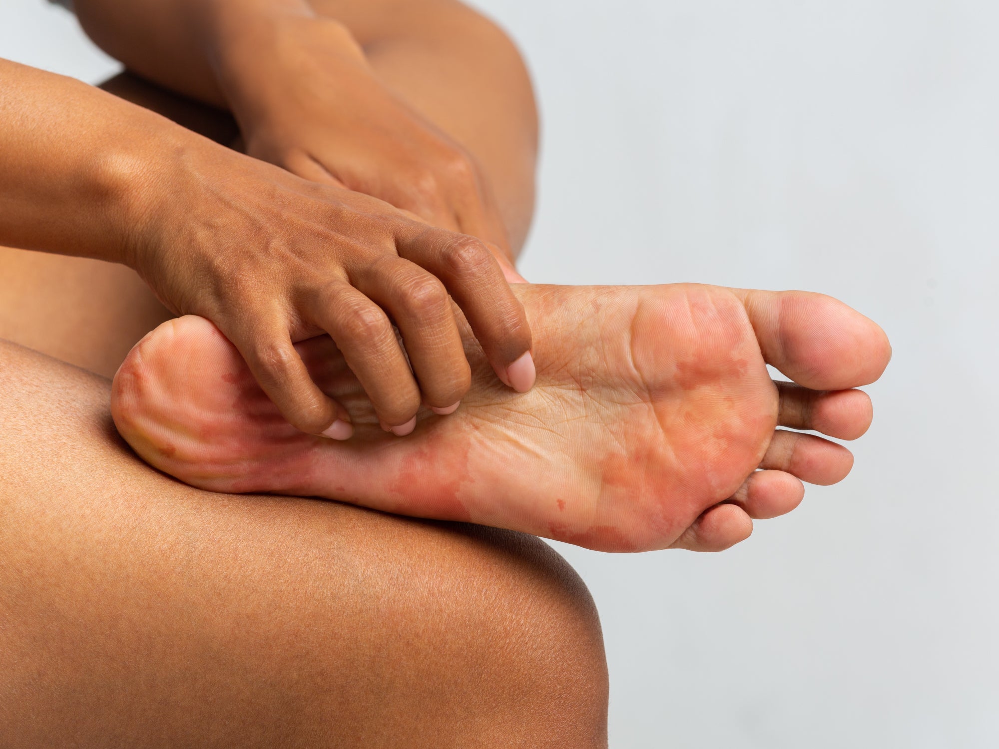 How To Soothe Diabetic Itchy Feet