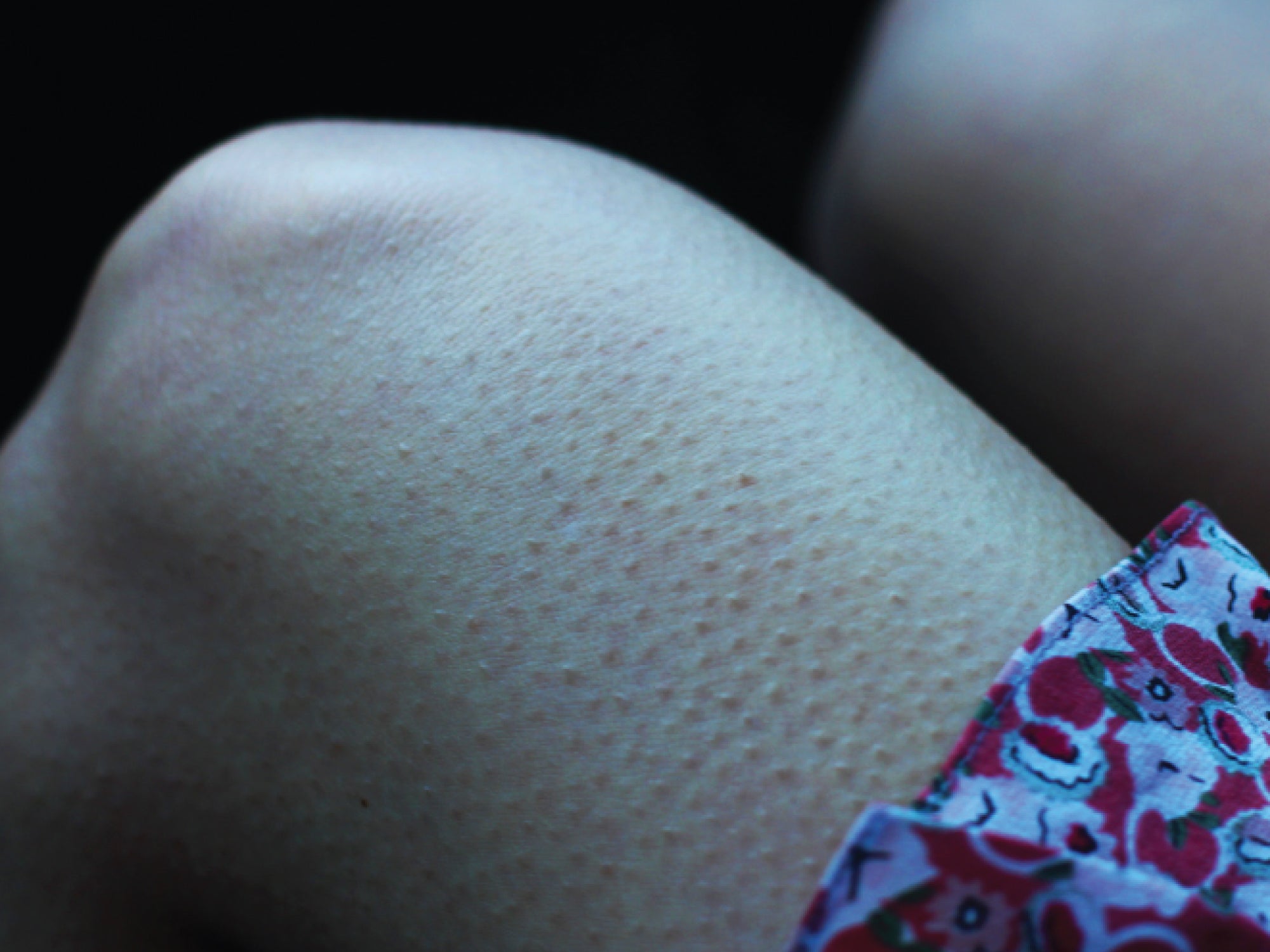 Help, I Have Chicken Skin! What Is Keratosis Pilaris & What Can I Do About It?