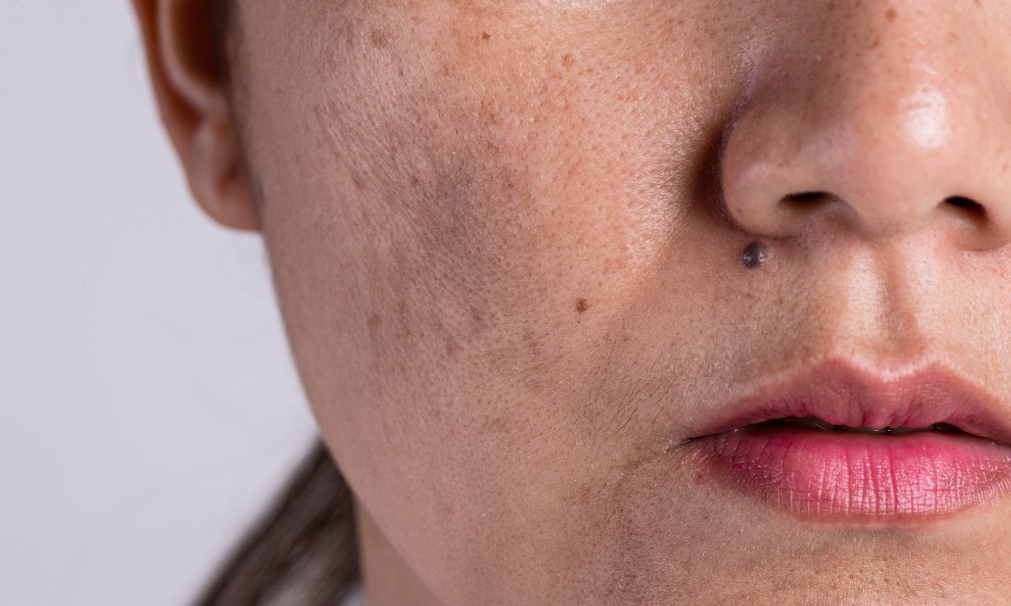 What Causes Post-Inflammatory Hyperpigmentation?