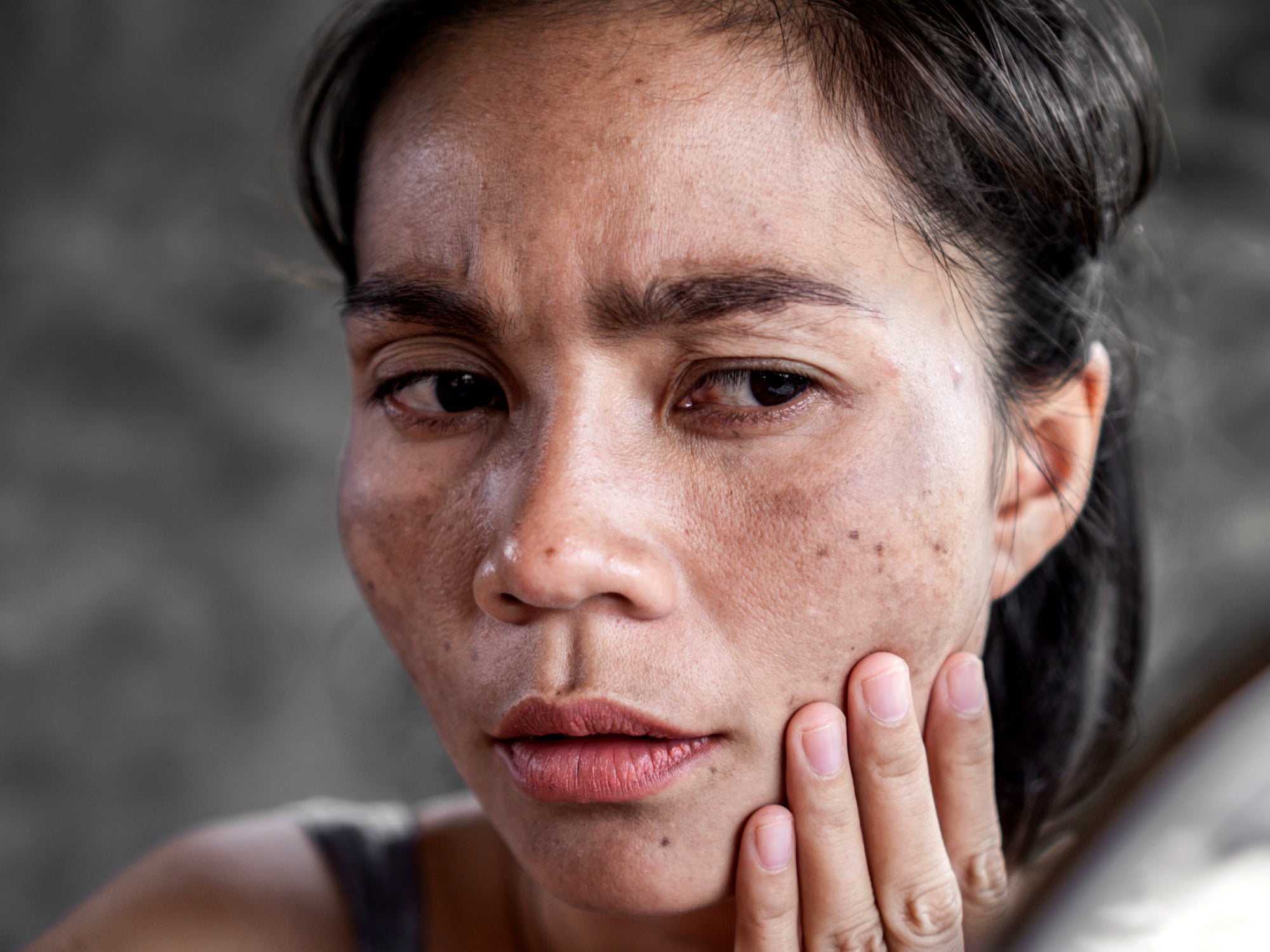 Is Post-Inflammatory Hyperpigmentation Permanent?