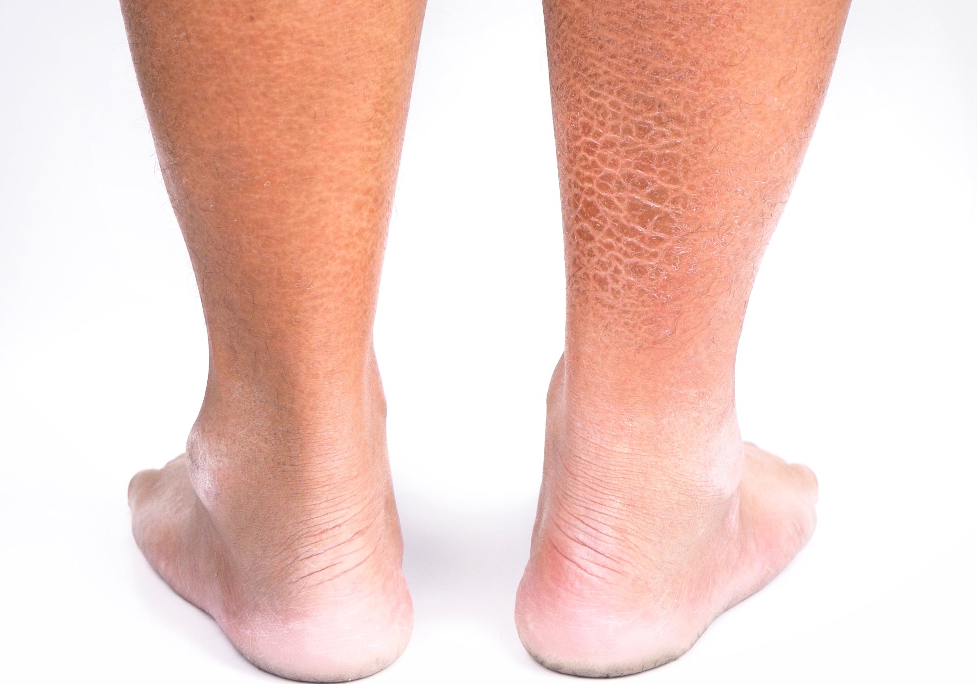 What Part Of The Skin Is Affected By Ichthyosis?