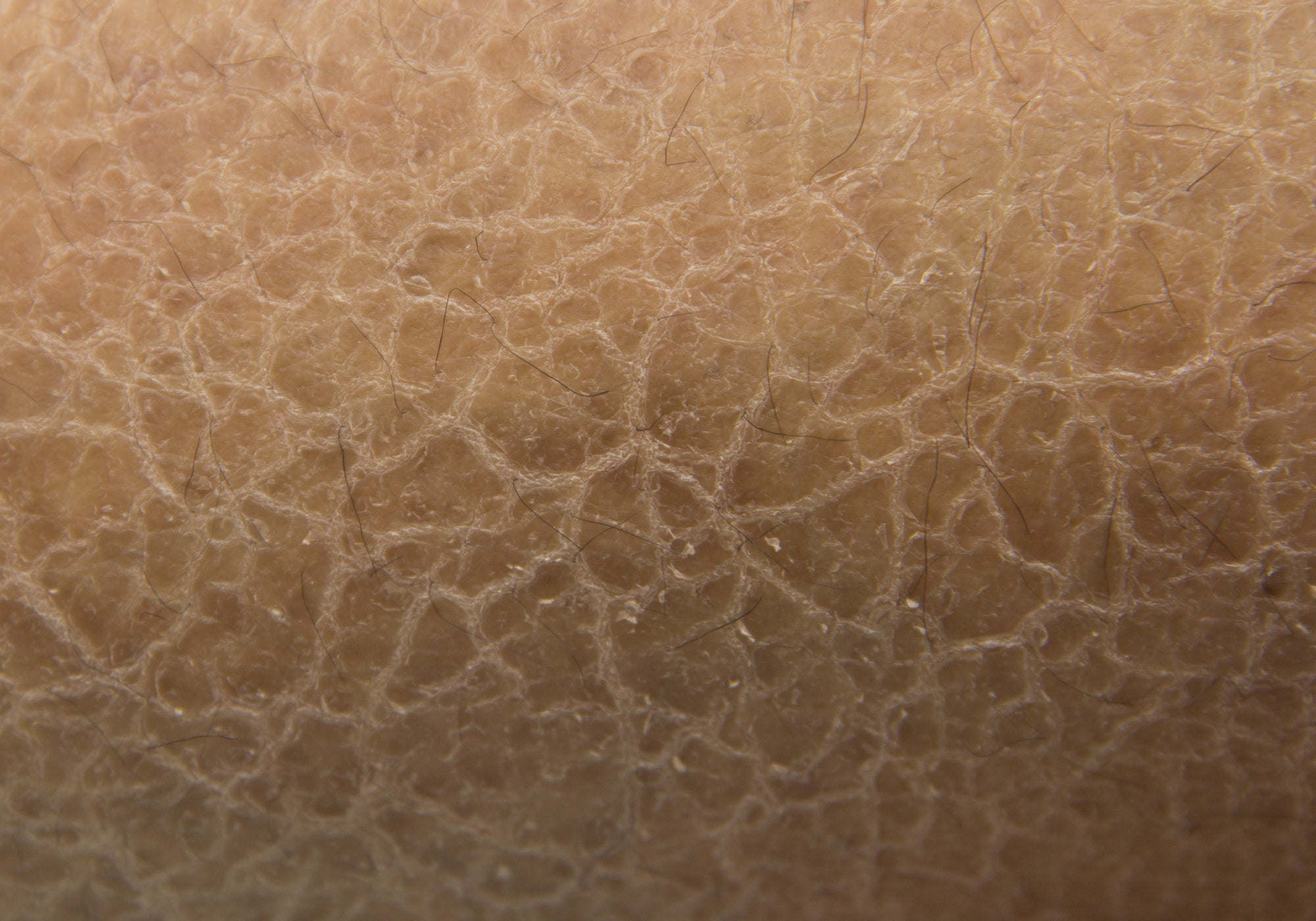 What Are The Symptoms Of Ichthyosis?