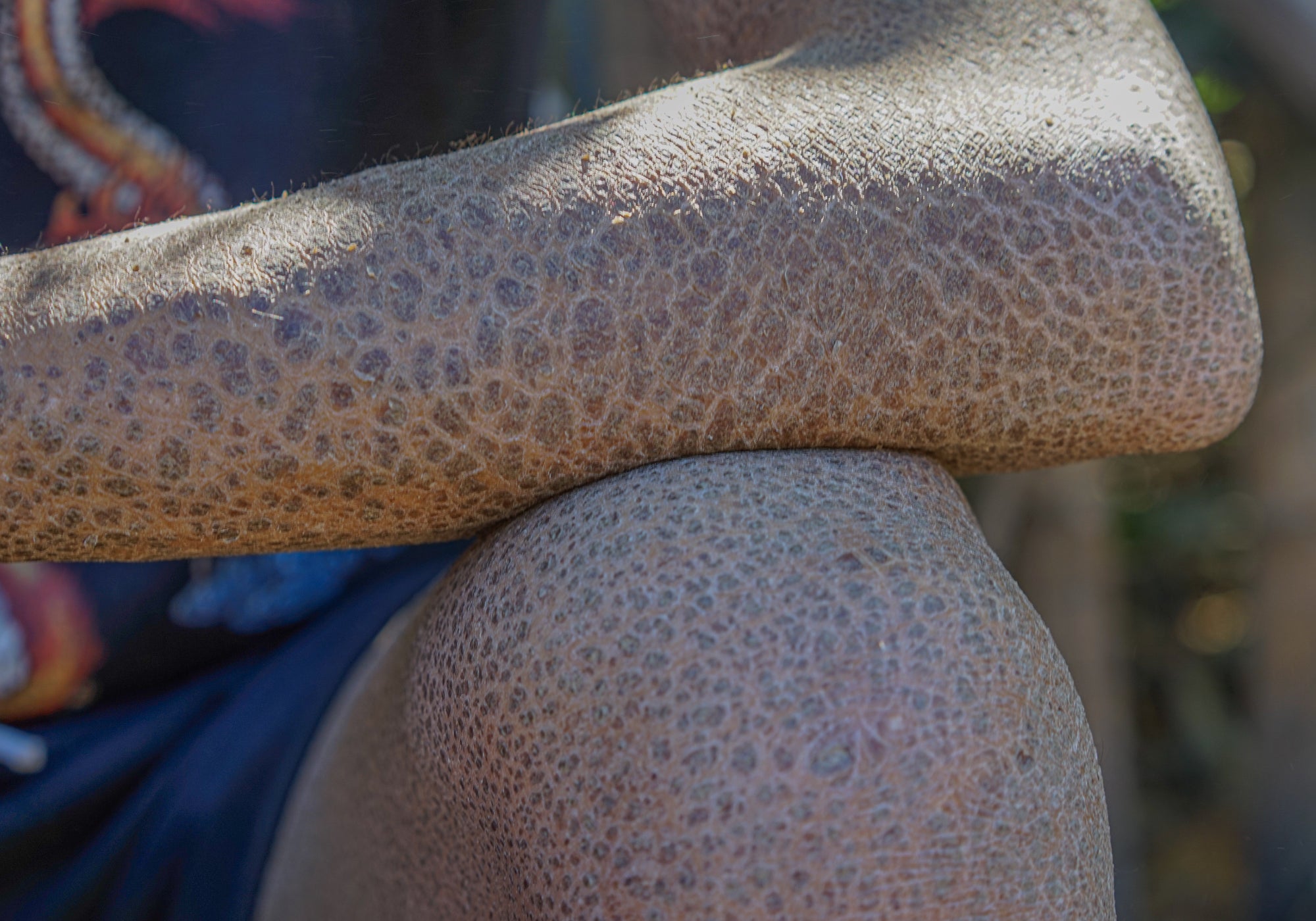 What Causes Ichthyosis Skin Disorder?