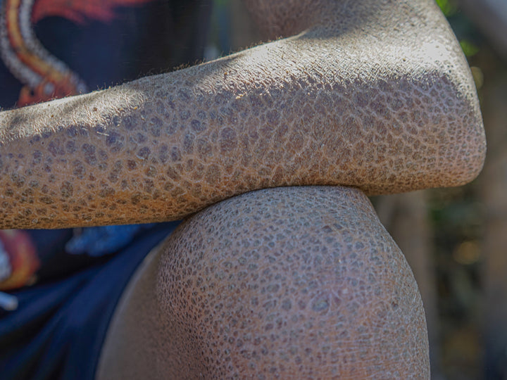 What Causes Ichthyosis Skin Disorder?