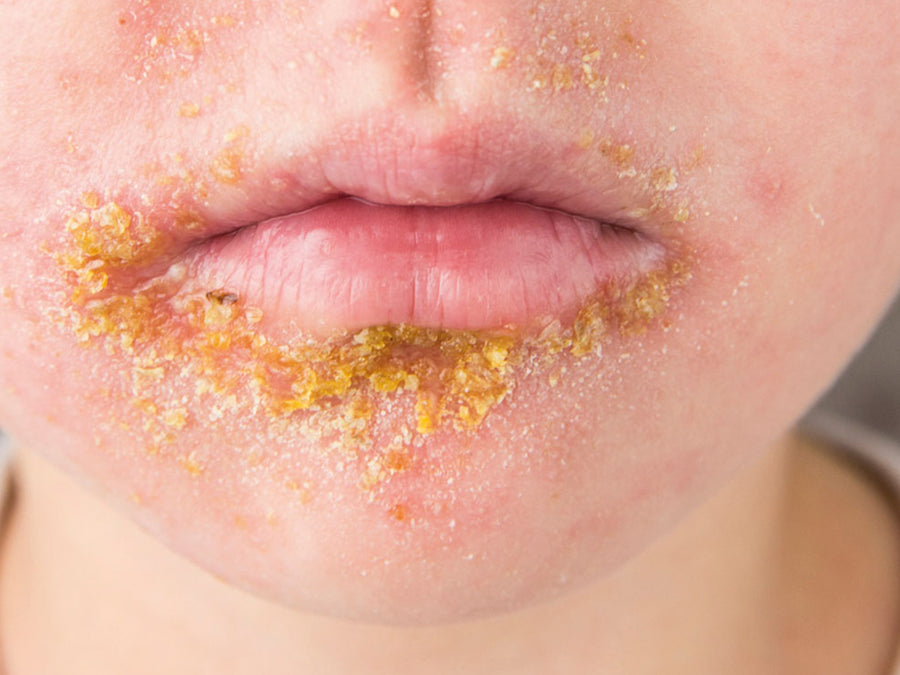 What Is The Difference Between Perioral Dermatitis And Impetigo?