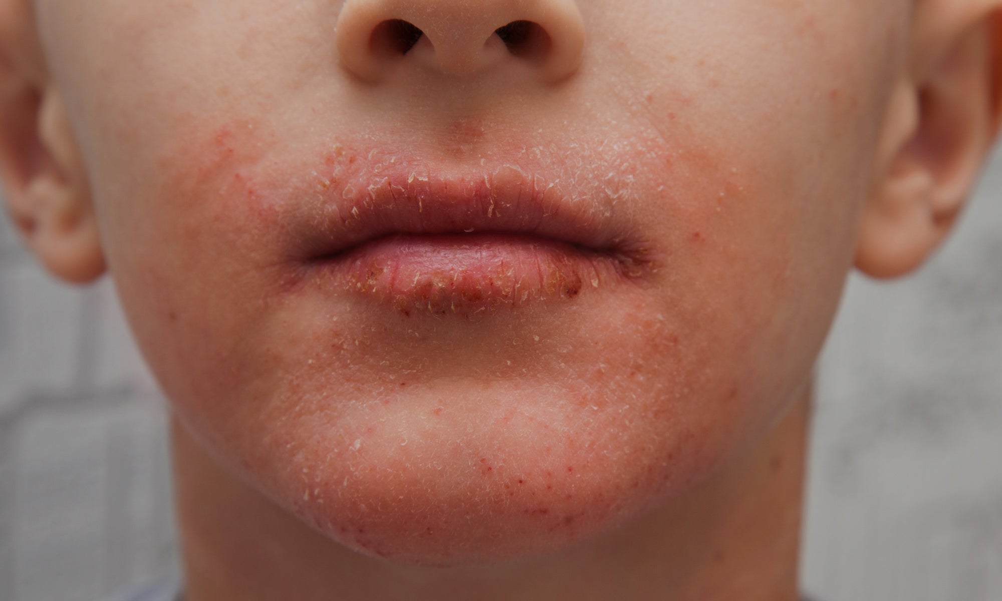 What Causes Perioral Dermatitis?