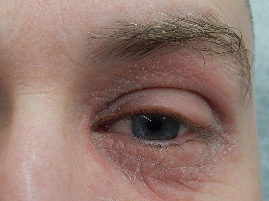 How To Treat Perioral (Periocular) Dermatitis Around The Eyes
