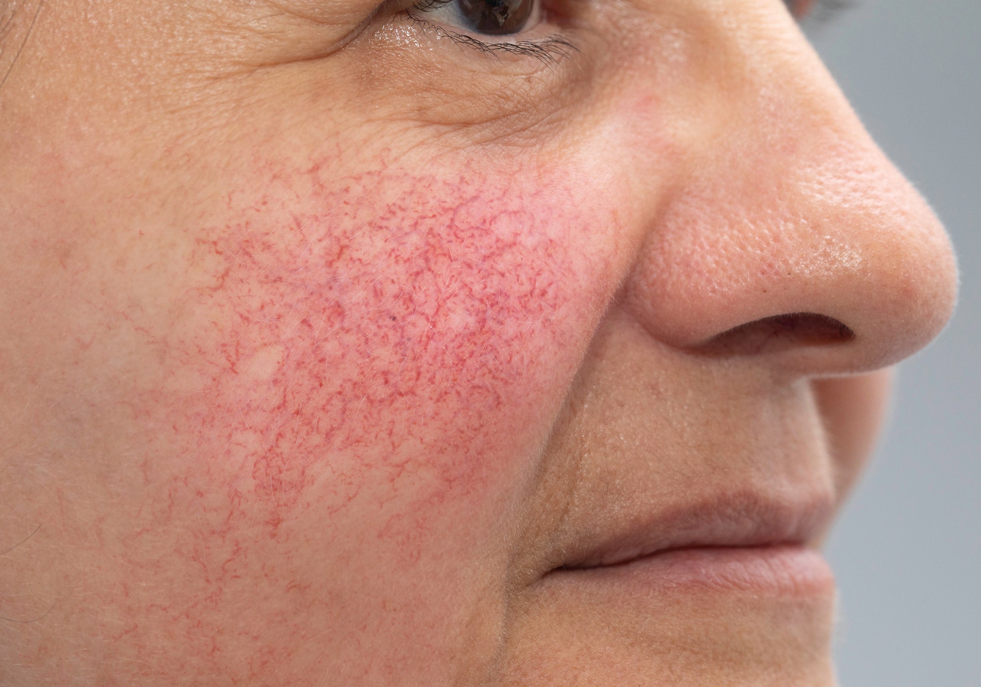 What Happens If Rosacea Is Left Untreated?