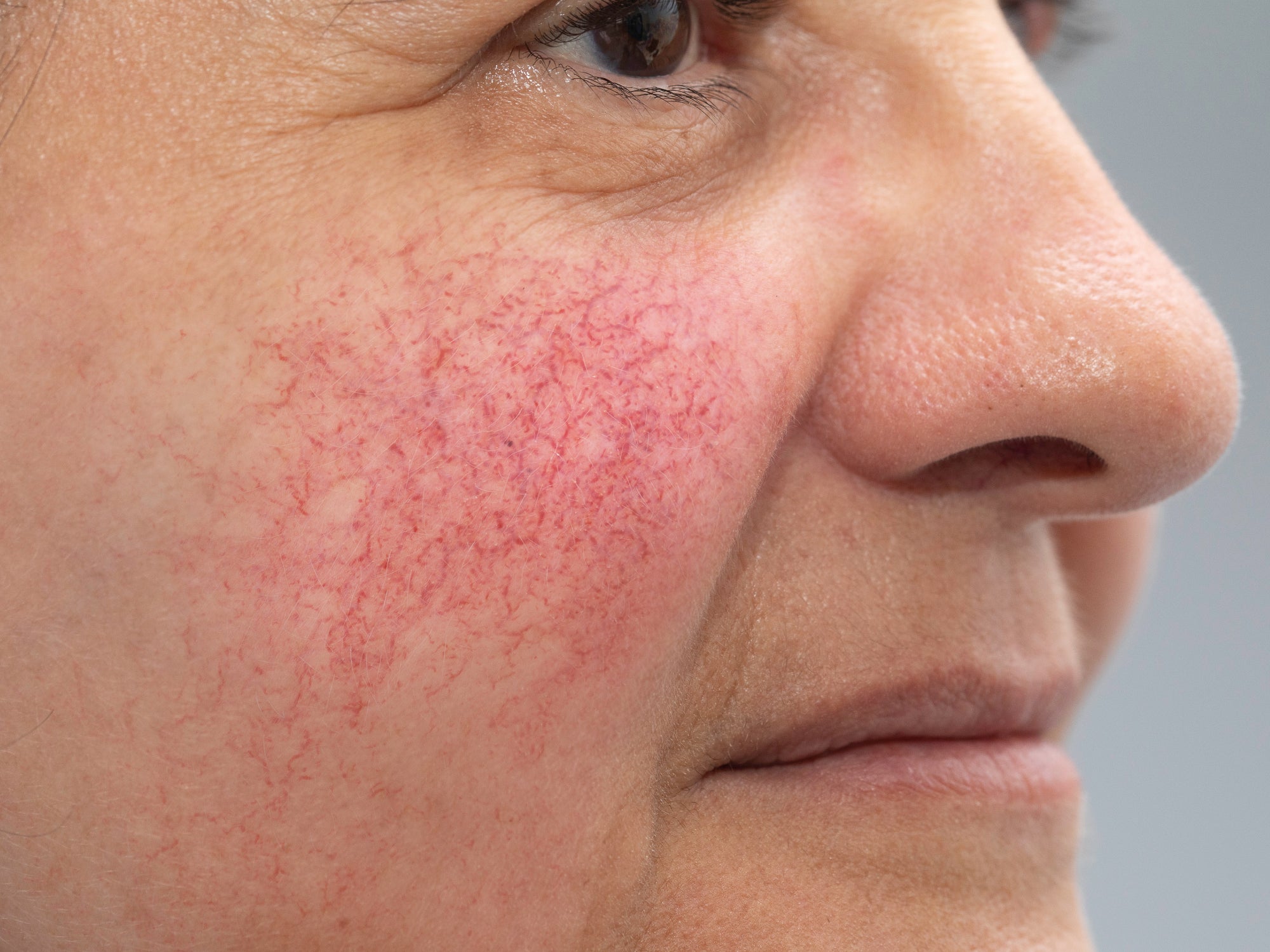 What Happens If Rosacea Is Left Untreated?