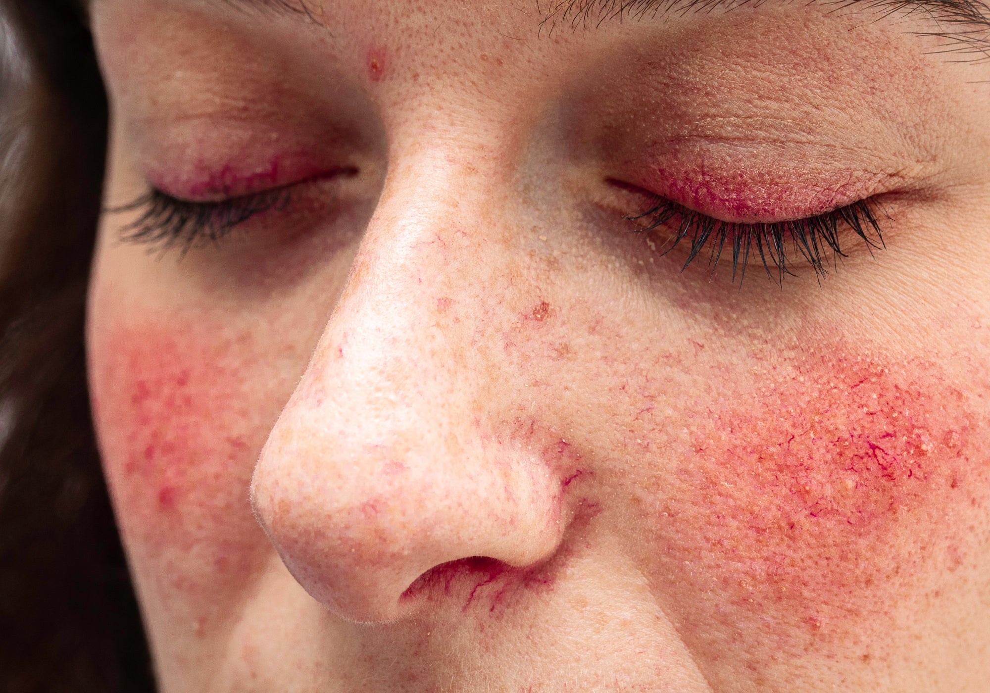 What Foods Trigger Rosacea?