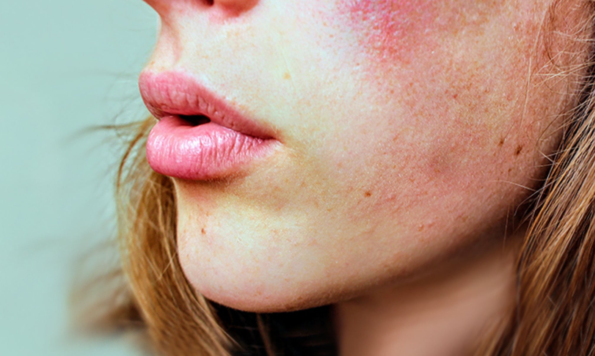 Is It Good To Have a Facial With Rosacea?