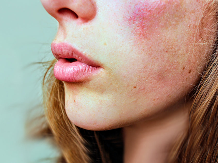 Is It Good To Have a Facial With Rosacea?