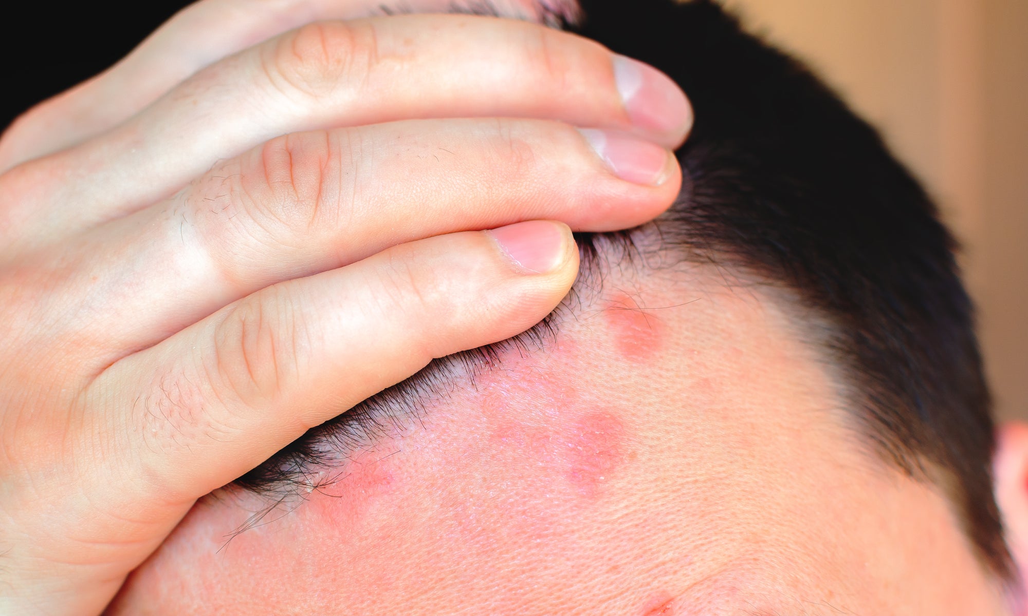 How To Get Rid Of Psoriasis Around The Hairline