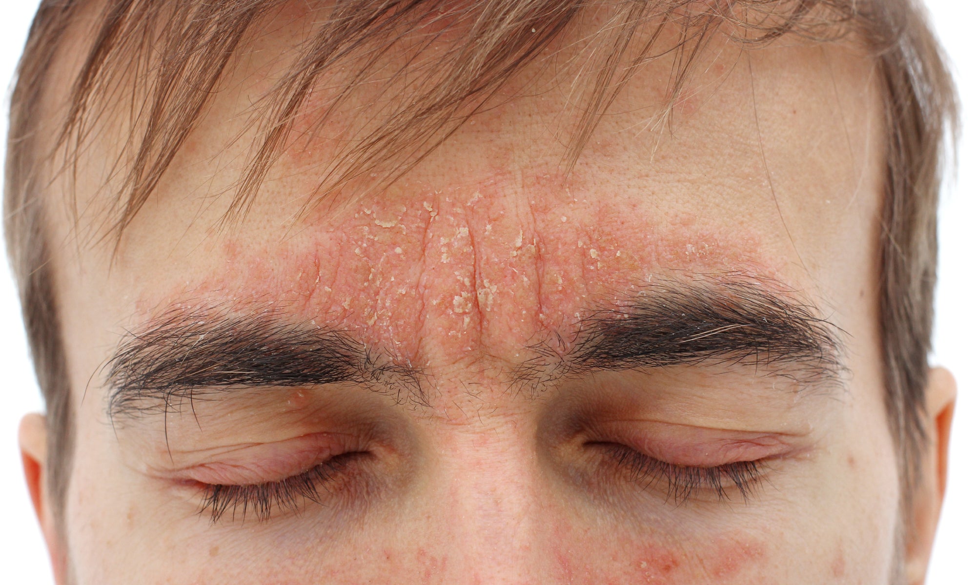 Is Seborrheic Dermatitis A Fungal Or Bacterial Infection?